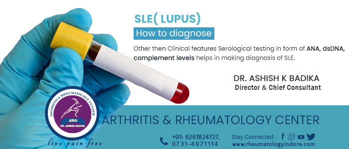 How to Diagnose SLE (Lupus) - Arthritis & Rheumatology Center