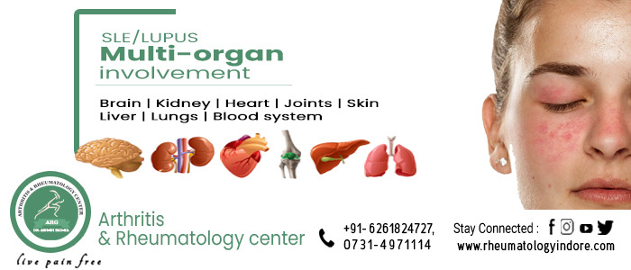 Systemic Lupus Erythematosu (SLE) with Multi-Organ Involvement - Dr. Ashish Baika