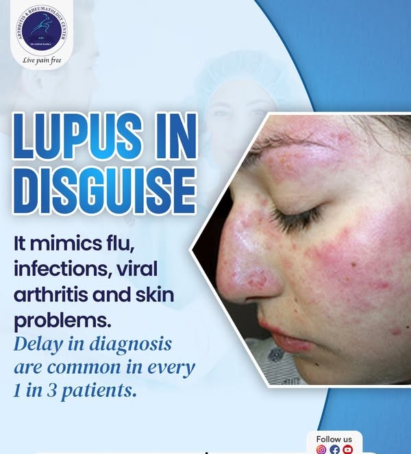 systemic lupus erythematosus doctor in indore, lupus treatment in indore